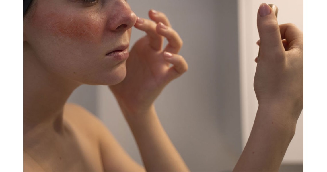 Understanding Rosacea: Symptoms, Triggers, and Treatments