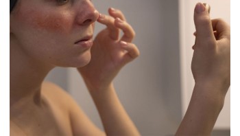 Understanding Rosacea: Symptoms, Triggers, and Treatments