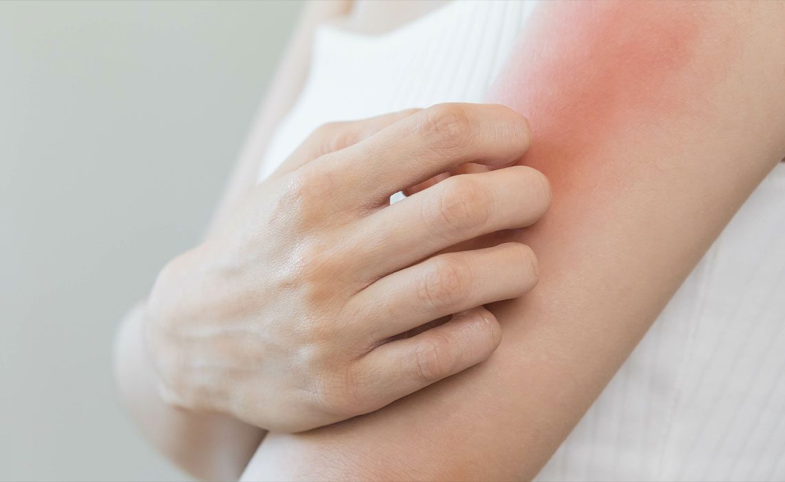 eczema triggers and skin support