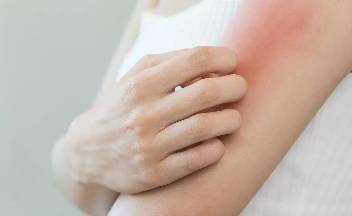 eczema triggers and skin support