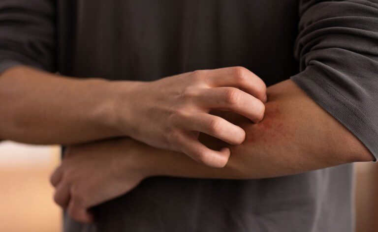 Atopic-Prone Skin