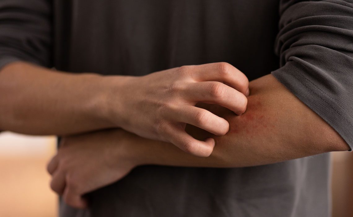 Atopic-Prone Skin