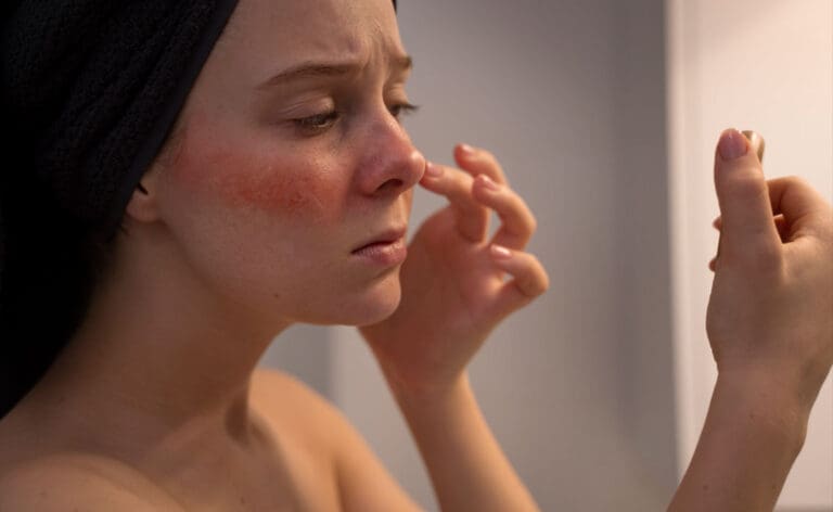 Rosacea and treatment options