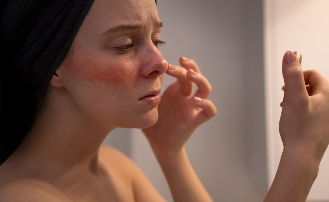 Rosacea and treatment options
