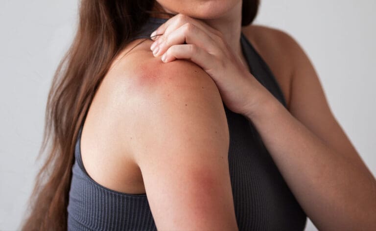Itchy Skin - Support with Kawakawa