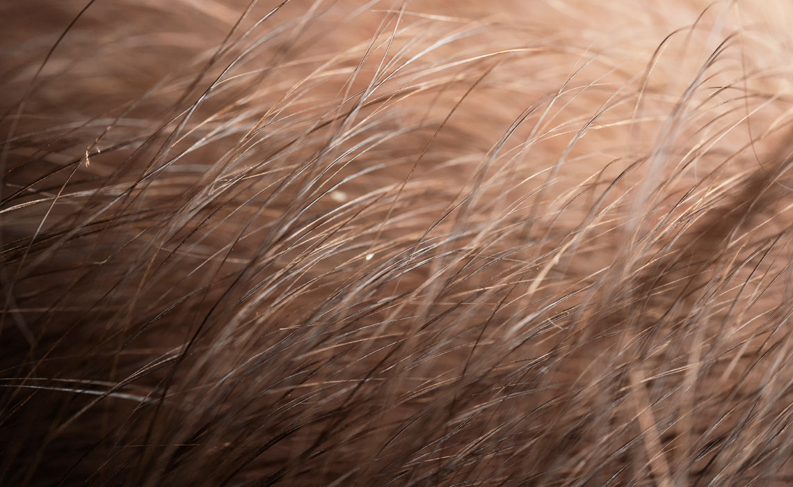 Illustration of typical yellowish flakes on an infant's scalp, representing cradle cap